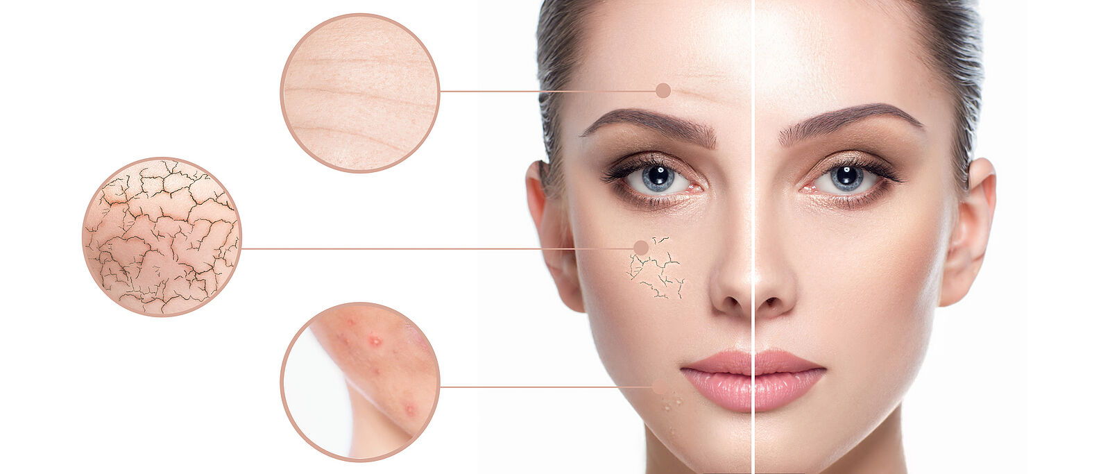 Female Face Close-up, Showing Skin Problems. Dry Skin, Acne, Wrinkles And Other Imperfections. Rejuv